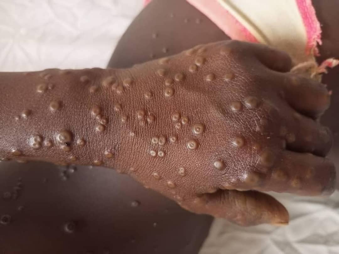 Lire la suite à propos de l’article Sud-Kivu : Des cas de MPOX alertés dans la zone de santé de Minova